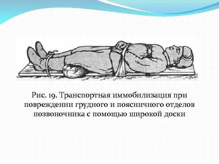 Иммобилизация при травме позвоночника алгоритм. Алгоритм первой помощи, иммобилизация при повреждениях позвоночника. Иммобилизация при переломе поясничного отдела позвоночника. Иммобилизация при повреждении поясничного отдела позвоночника.