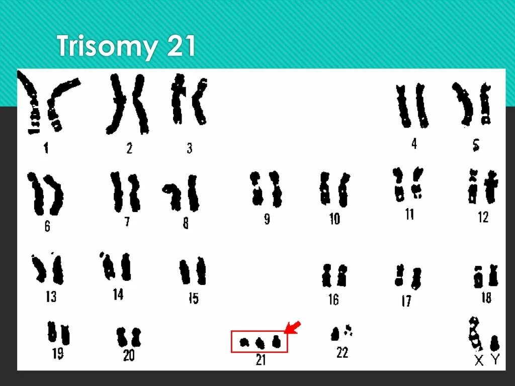 Кариотип человека с синдромом Дауна. Кариотип при синдроме Дауна. Кариотип больного с синдромом Дауна. Болезнь Дауна кариотип. Наличие лишней хромосомы