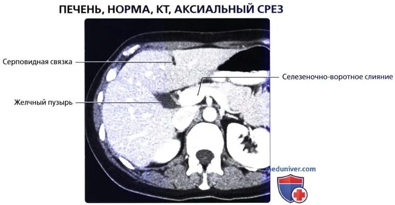 Сегменты печени на кт анатомия. Серповидная связка печени на кт. Круглая связка печени на кт. Связки печени кт анатомия. Кт норма печень