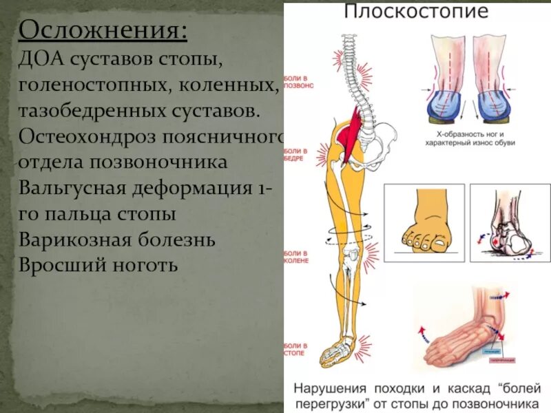 Деформирующий остеоартроз осложнения. Осложнения деформирующего остеоартроза. Осложнения деформирующего остеоартроза коленного сустава.