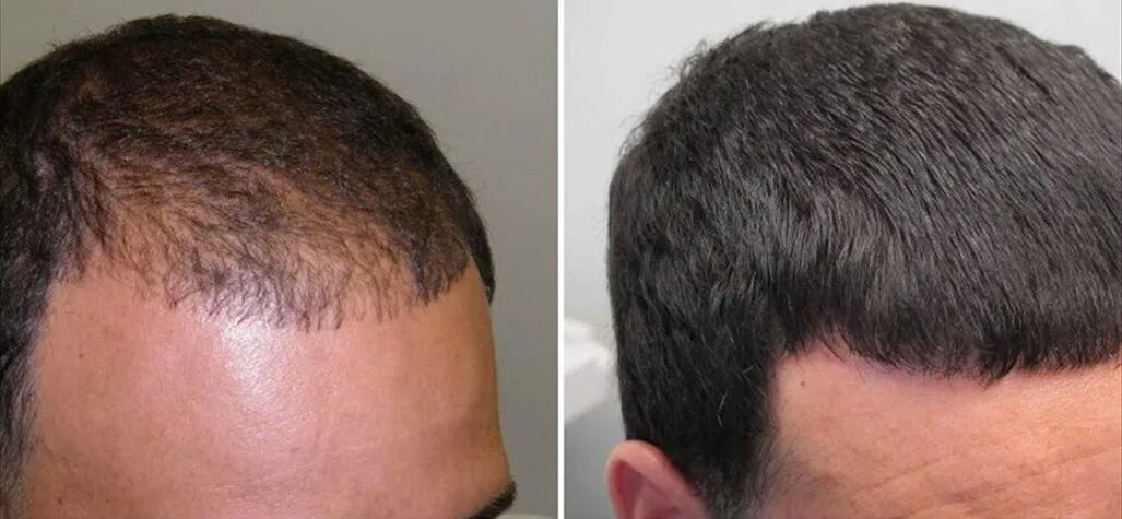 Результаты роста волос. Миноксидил для волос для мужчин для головы. Трихопигментация очаговая алопеция. Миноксидил лобные залысины.