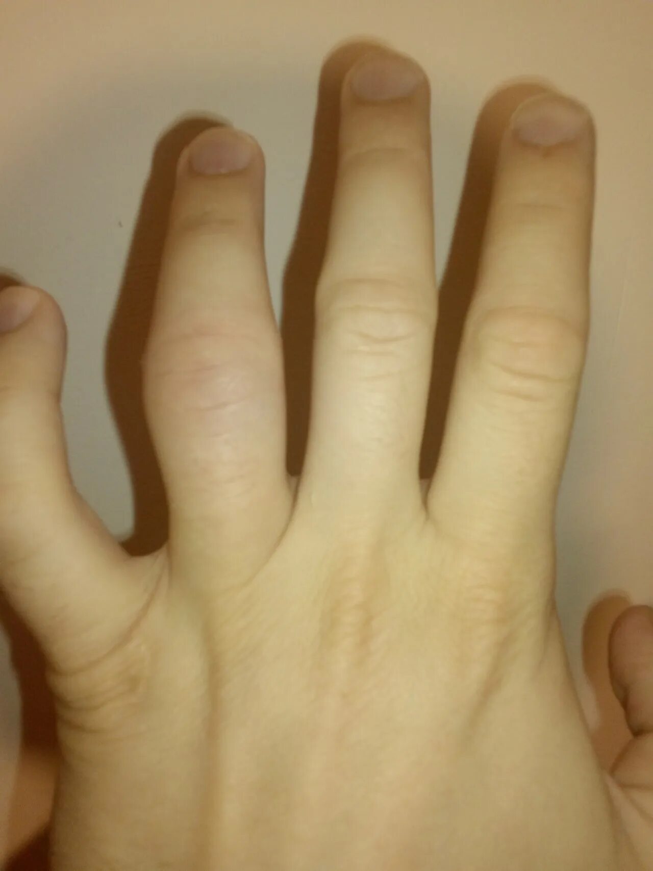 Суставы пальцев сильно. Перелом указательного пальца.