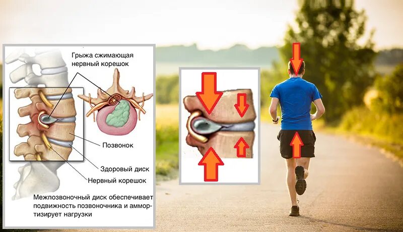 Что можно после грыжи. Грыжа позвоночника. При грыже поясничного отдела позвоночника. Бег при грыже поясничного отдела. Грыжа позвоночника поясничного отдела.