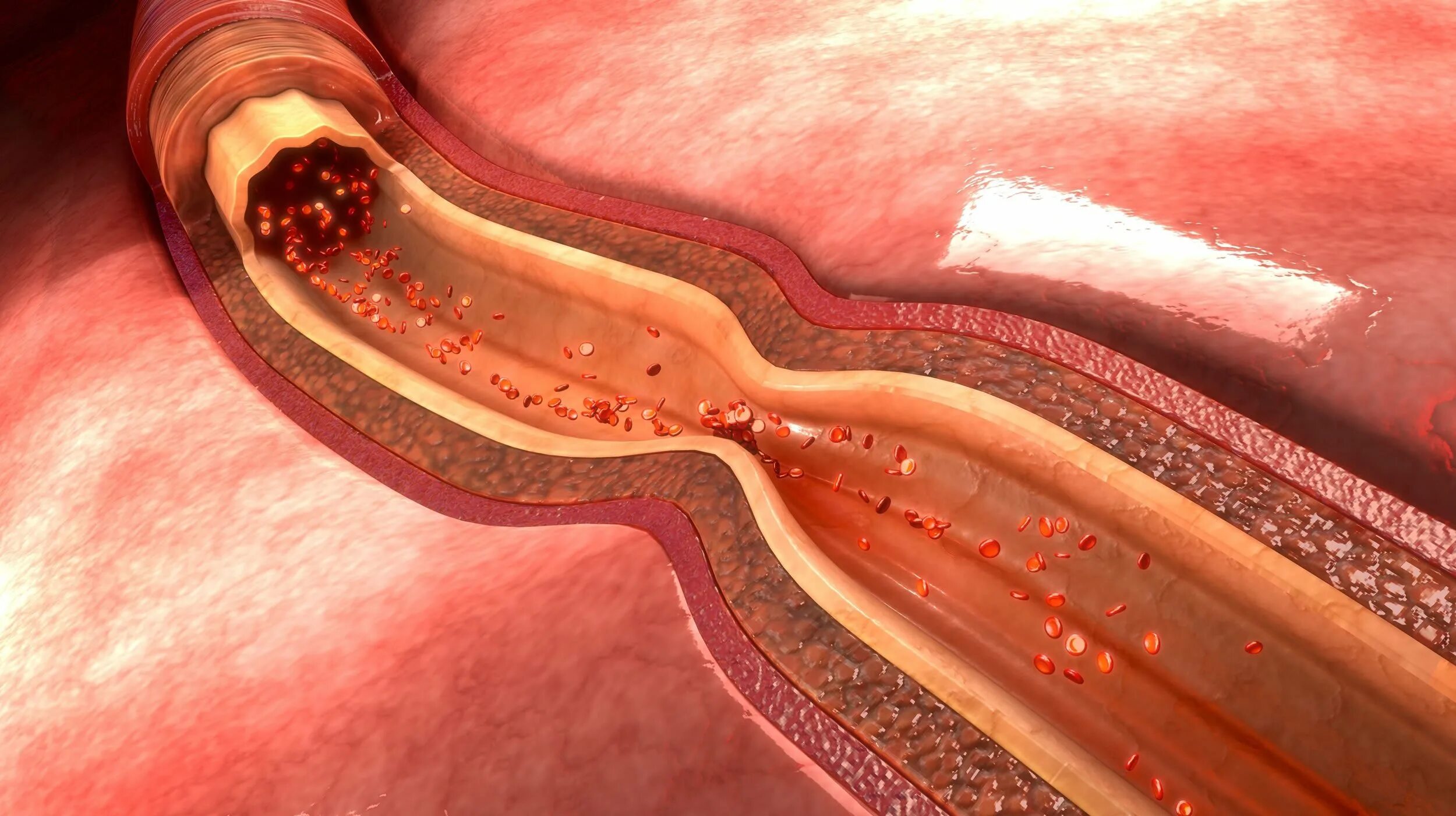 Спазм коронарных артерий. Сдавление кровеносного сосуда. Почему спазм сосудов
