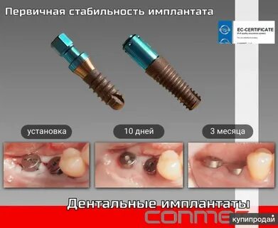 Замена имплантов отзывы