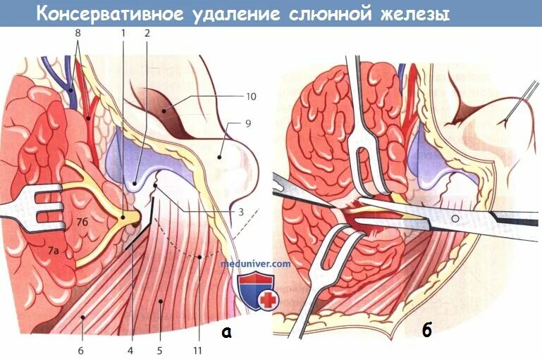 Околоушная железа операция. Субтотальная резекция околоушной железы. Операции на околоушной железе. Операция паротидэктомия. Субтотальная резекция околоушной слюнной железы.