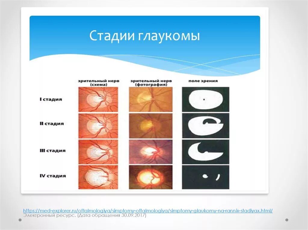 Открытоугольная глаукома этиология. Терминальной стадии первичной глаукомы. Первичная открытоугольная глаукома развитой стадии. Глаукома открытоугольная по стадиям. Классификация глаукомы