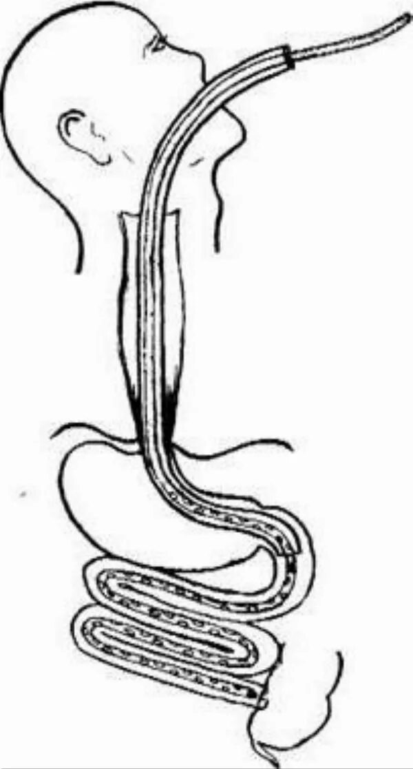 Трубка через рот. Назоинтестинальная интубация. Зонд Эббота Миллера. Назогастральная интубация. Назогастральная интубация кишечника.