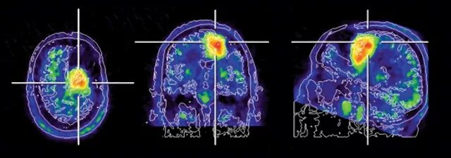 ПЭТ кт опухоли головного мозга. Позитронно-эмиссионная томография мозга. Позитронно-эмиссионная томография мозга (ПЭТ). ПЭТ кт с метионином головного мозга. Пэт с тирозином