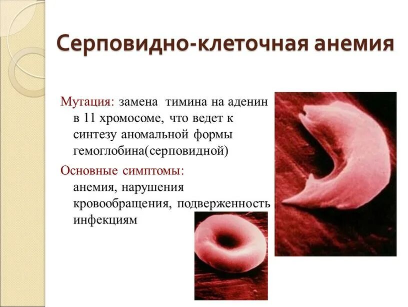 Гемоглобин серповидноклеточная анемия. Серповидно клеточная анемия клиника. серповидноклеточная анемия мутация. серповидноклеточная анемия диагностика генетика.