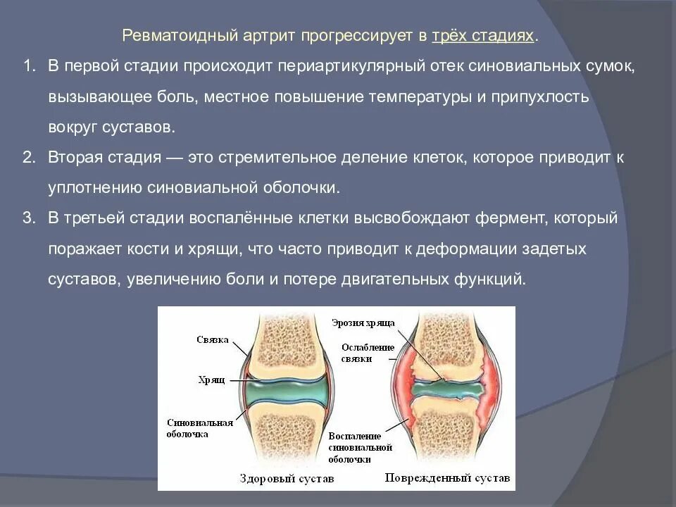 Артрит это. Ревматоидный артрит морфологическая характеристика стадий синовита. Ревматоидный артрит синовиальная жидкость. Степени артрита коленного сустава ревматоидный. Артроидный ревматизм суставов.