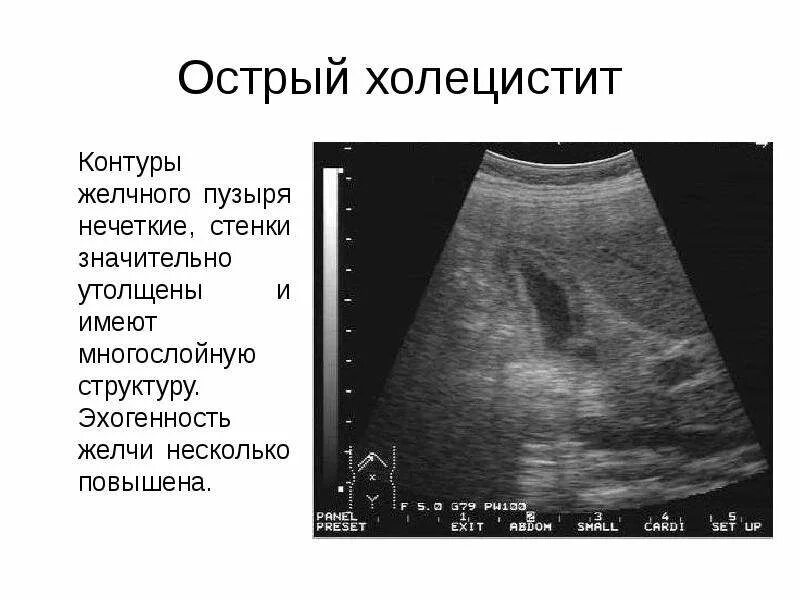 Утолщение стенки желчного пузыря на УЗИ. Двойной контур стенки желчного пузыря. Двойная стенка желчного пузыря на УЗИ. Повышенная эхогенность паренхимы печени что это значит