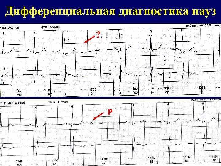 Смад pause