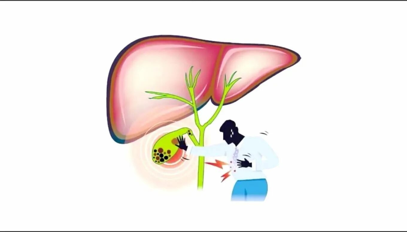 Печень без желчного. ЖКБ желчного пузыря профилактика. Камни из желчного пузыря. Профилактика холецистита картинки.
