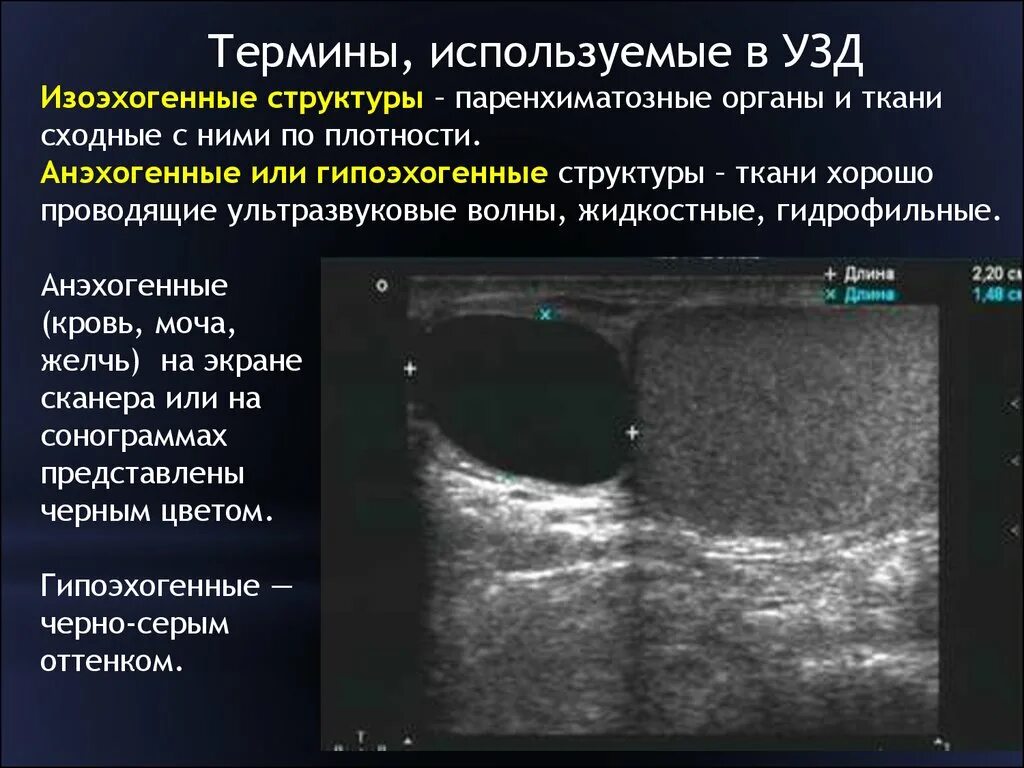 Образование анэхогенной структуры. Эхогенность и анэхогенность. анэхогенное гипоэхогенное изоэхогенное образование. гипоэхогенные структуры на узи печени. изоэхогенное образование.