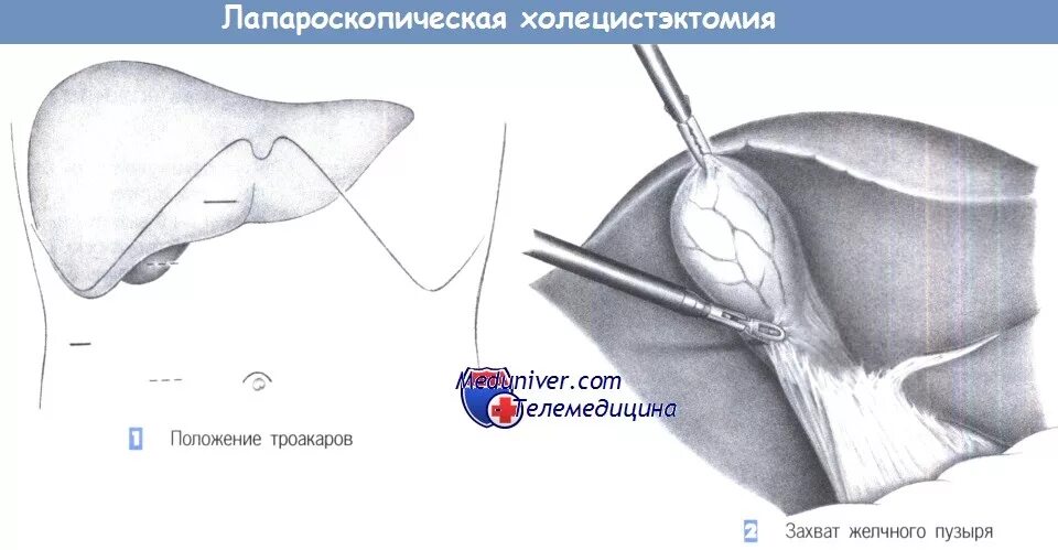 Месяц после холецистэктомии. Холецистэктомия желчного пузыря лапароскопическая. Лапароскопическая холецистэктомия троакары. Холецистэктомия треугольник Кало. Желчный лапароскопия дренаж.