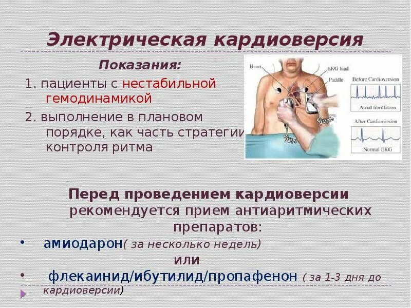 Фибрилляция дефибриллятор