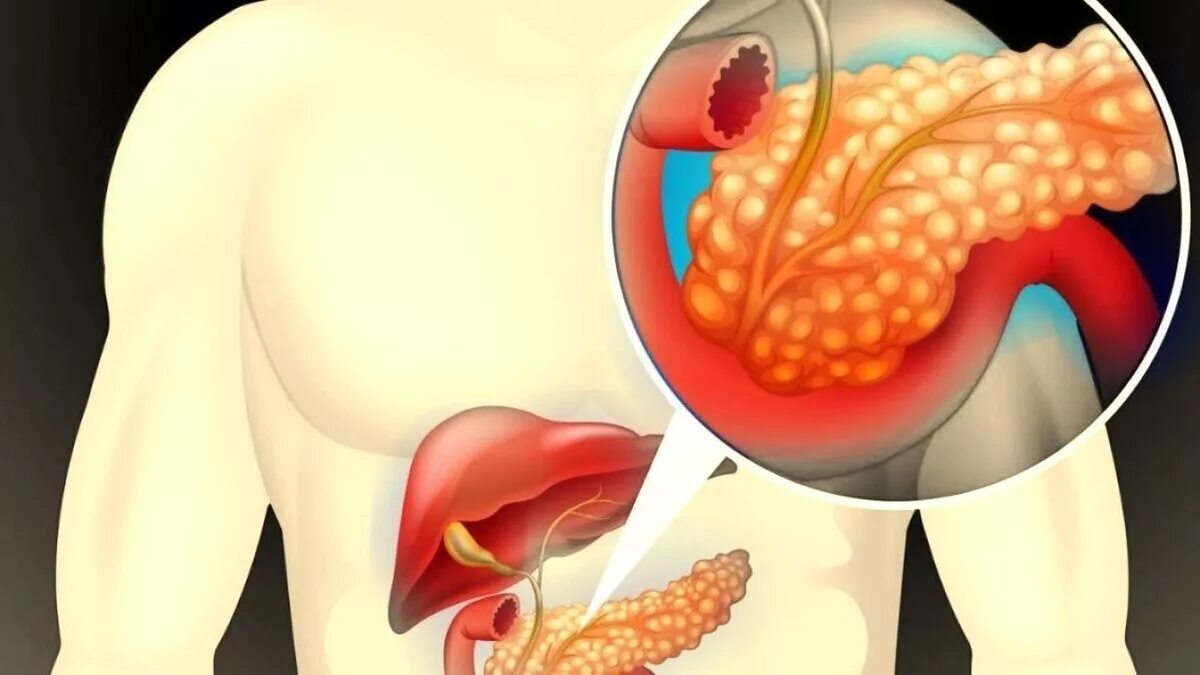 Боль в поджелудочной железе врач. Хронический панкреатит поджелудочная железа. Панкреатит воспаление поджелудочной железы. Острый панкреатит поджелудочной железы. Обструкция поджелудочной железы.