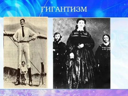 Гигантизм сахарный диабет