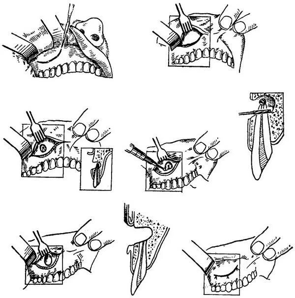 цистэктомия с резекцией верхушки корня. резекция верхушки корня зуба. резекция верхушки корня методика операции. резекция зуба операция. резекция верхушки корня ампутация корня.
