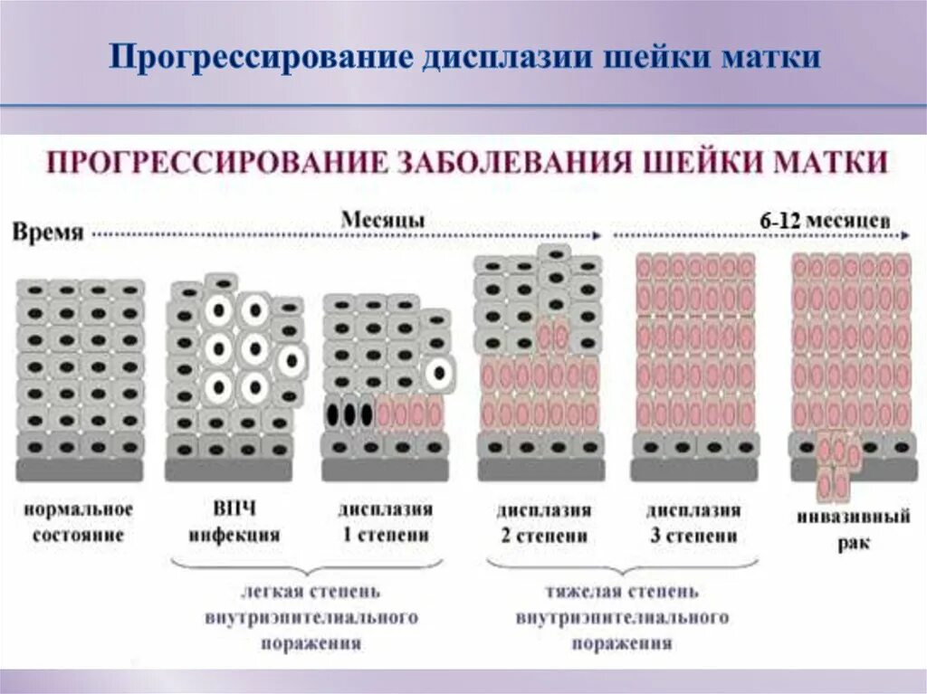 После лечения дисплазии. Дисплазия шейки матки 2 степени гистология. Гистологическая классификация дисплазий шейки матки. Дисплазия шейки матки Cin 1-2. Дисплазия шеечного эпителия.