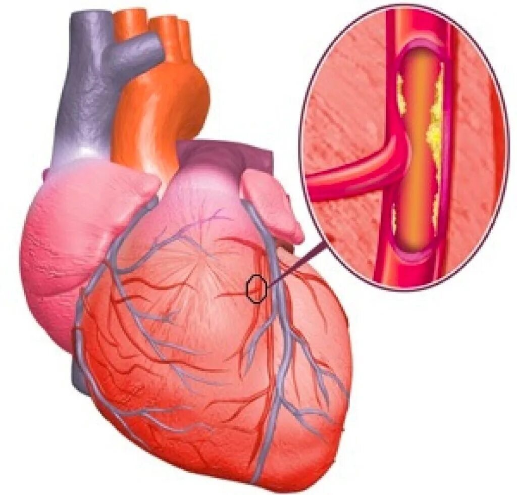 ИБС стенокардия атеросклероз симптомы. Атеросклероз венечных артерий сердца. Ишемическая болезнь сердца (ИБС). Тромбоз коронарной артерии. Расширяет коронарные сосуды