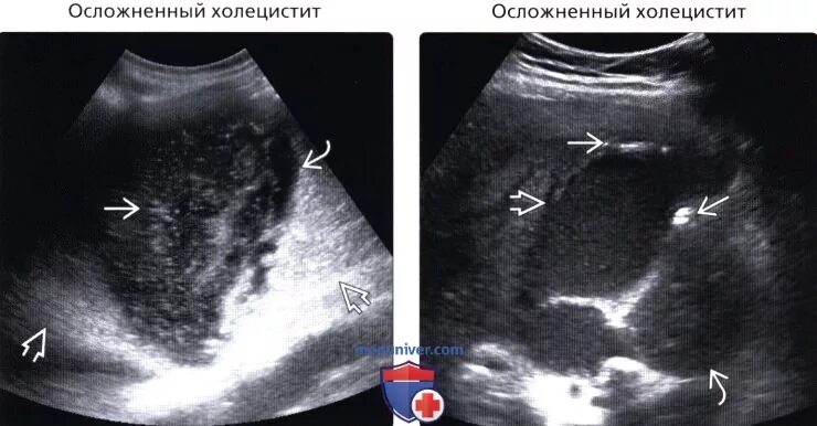 Эхогенный желчный пузырь. Анэхогенное содержимое желчного пузыря что это. Неоднородное содержимое желчного пузыря. Желчный пузырь с эхогенным содержимым. Гетерогенное содержимое в желчном пузыре.