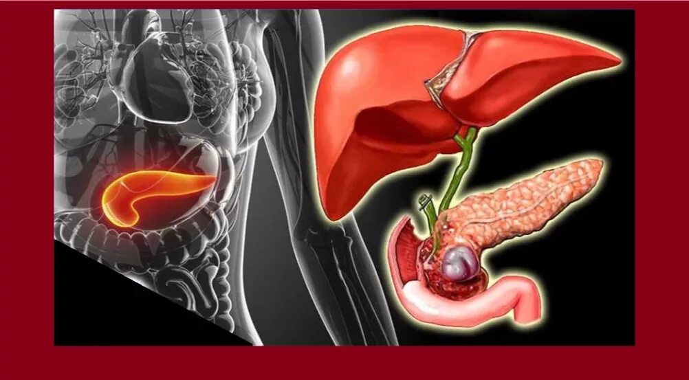 Поджелудочная железа острые боли. Панкреатит воспаление поджелудочной железы. Хроническое воспаление поджелудочной железы. Хронический панкреатит. Воспаленная поджелудочная железа.