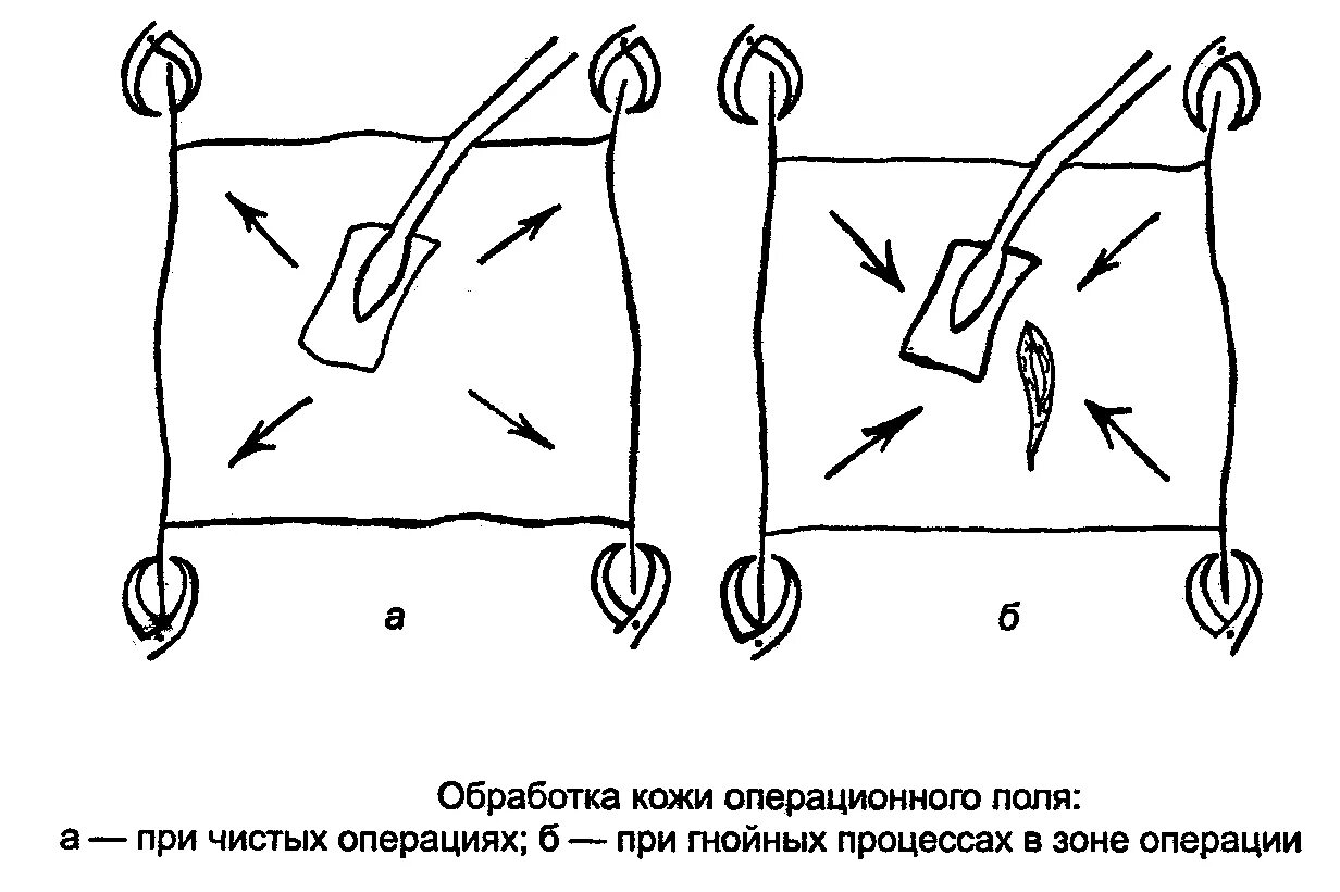 Обработка кожи операционного поля. Подготовка операционного поля алгоритм хирургия. Обработка кожи операционного поля алгоритм. Подготовка операционного поля - обработка операционного поля.