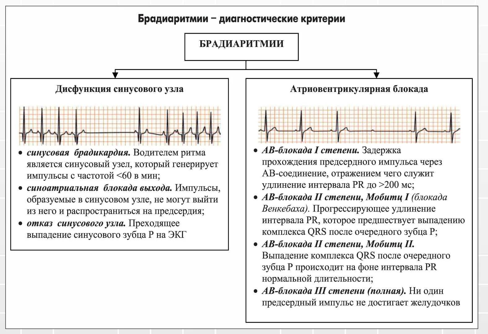 Синусовая брадикардия сердца у подростка. Брадиаритмии экг критерии. синусовая дыхательная аритмия у детей 7 лет. критерии синусовой аритмии у детей. синусовая дыхательная брадиаритмия экг.