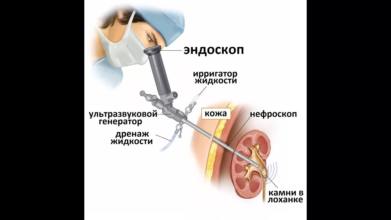 Сколько стоит операция по удалению камней. Контактная литотрипсия камней мочеточника через уретру. Перкутанная нефролитолапаксия ход операции. Трансуретральная литотрипсия. Дистанционная литотрипсия.