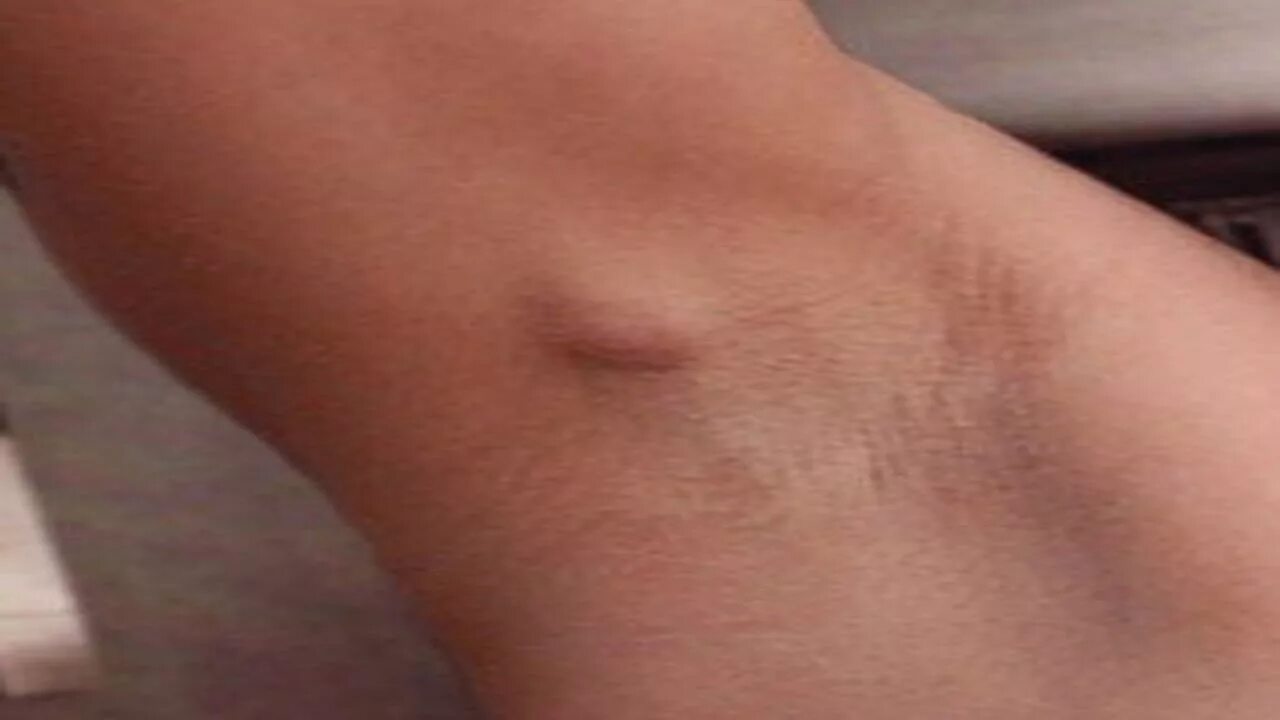 Home remedies for armpit lumps armpit lump treatment - YouTube