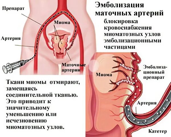 Эма миомы матки. Эмболизация сосудов матки. эмболизация ветвей маточных артерий. эмболизация маточных артерий при миоме матки. эма- эмболизация маточных сосудов.