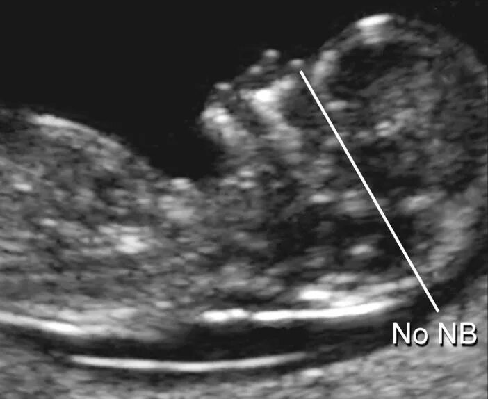 узи плода с синдромом дауна в 20 недель беременности. твп и носовая кость на 1 скрининге. твп узи 13 недель. носовая кость узи плода. узи плода с синдромом дауна в 12 недель.