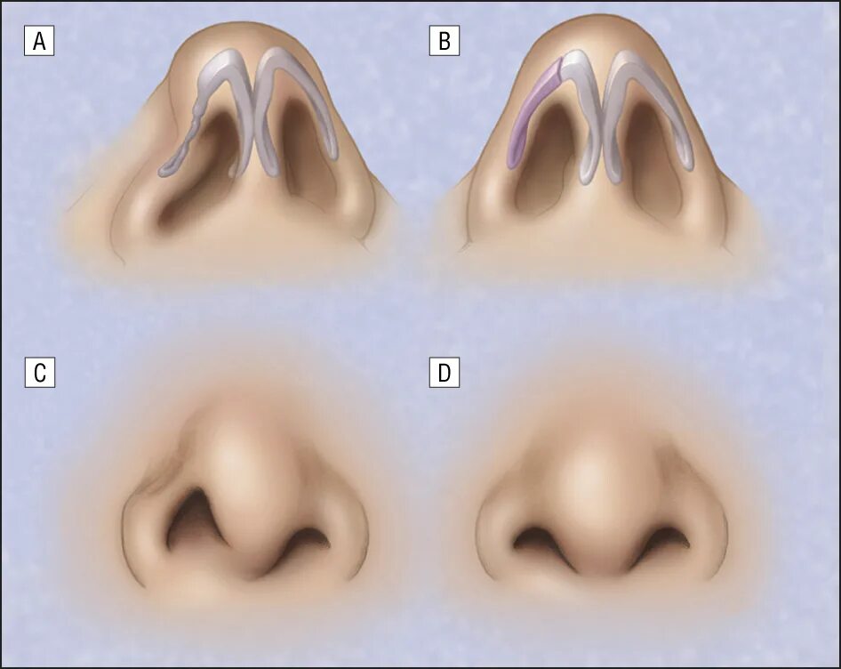 File:Septal Hematoma.png - Wikipedia