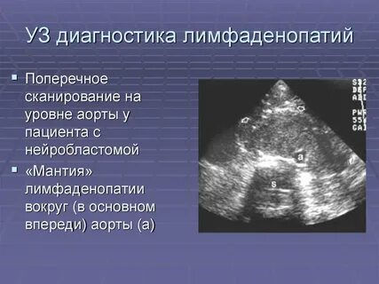 Лимфаденопатия брюшной полости