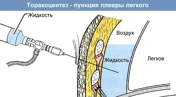 Почему после операции скапливается жидкость