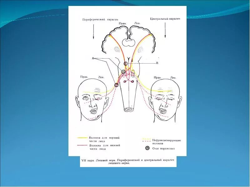 Поражение двигательного нерва. Лицевой нерв путь схема неврология. Ход лицевого нерва неврология. Поражение лицевого нерва схема. Двигательные Нейроны лицевого нерва.
