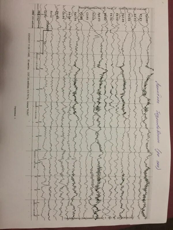 Ээг чебоксары. Гипсаритмия на ЭЭГ. Заключение ЭЭГ гипсаритмия. ЭЭГ ребенку 6 лет. ЭЭГ ребенку 4 года.