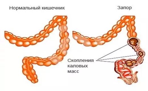 Спастический запор. Атонический запор. Спастический запор кал.