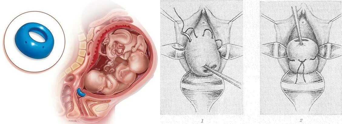 Операция опущения шейки. Серкляж истмико цервикальная. Абдоминальный серкляж. Шов на шейку матки при беременности. Трансабдоминальный серкляж.