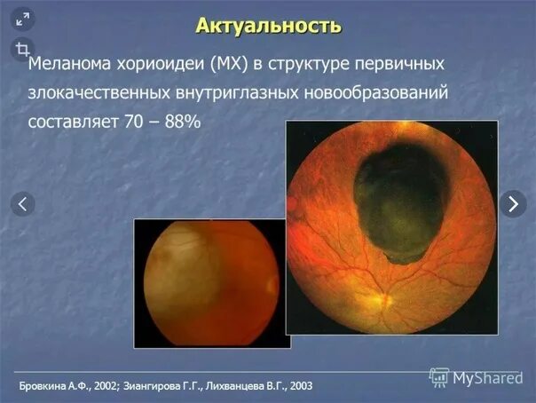 Новая технология определяет тип глаукомы без дискомфорта