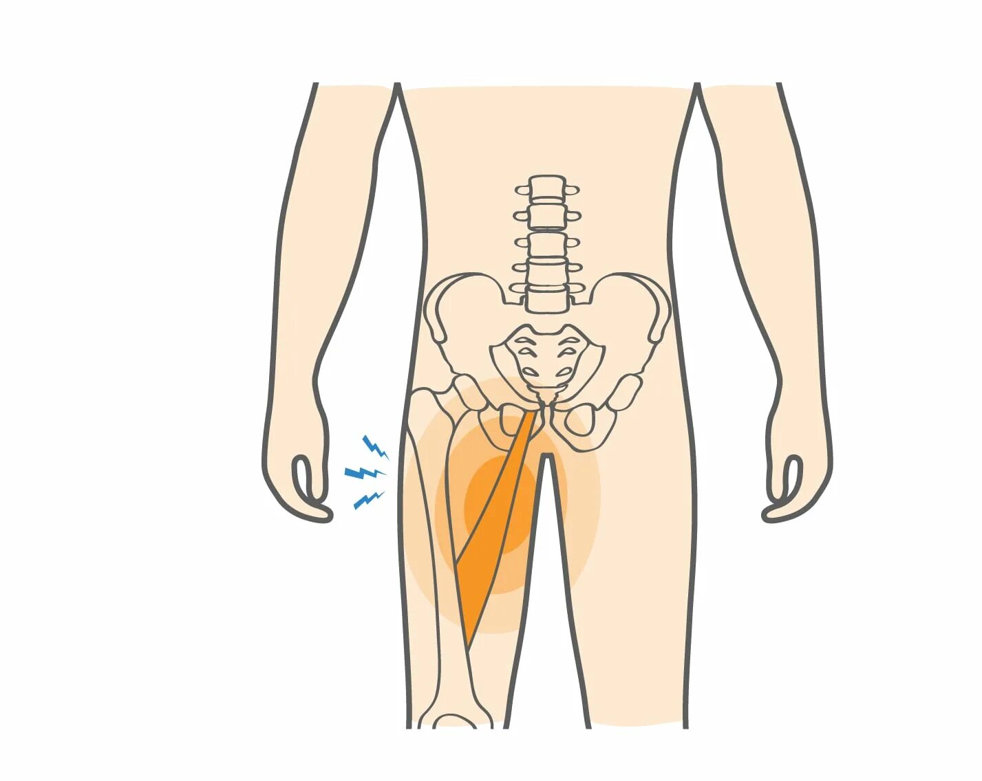 Поясница отдает в пах у мужчин. Вертельная точка бедра. Gluteus Medius Tendinosis. Вертел бедренной кости. Пальпация большого вертела бедра.