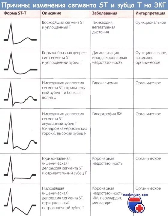 Зубцы в сегменте St на ЭКГ. Депрессия St v4-v6 ЭКГ. Сегмент St на ЭКГ В норме. Отрицательный сегмент St на ЭКГ.