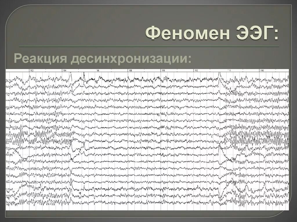 Ээг 6. Синхронизация десинхронизация ЭЭГ. Реакция десинхронизации на ЭЭГ. Десинхронизация ритма ЭЭГ это. Феномен Банко на ЭЭГ.