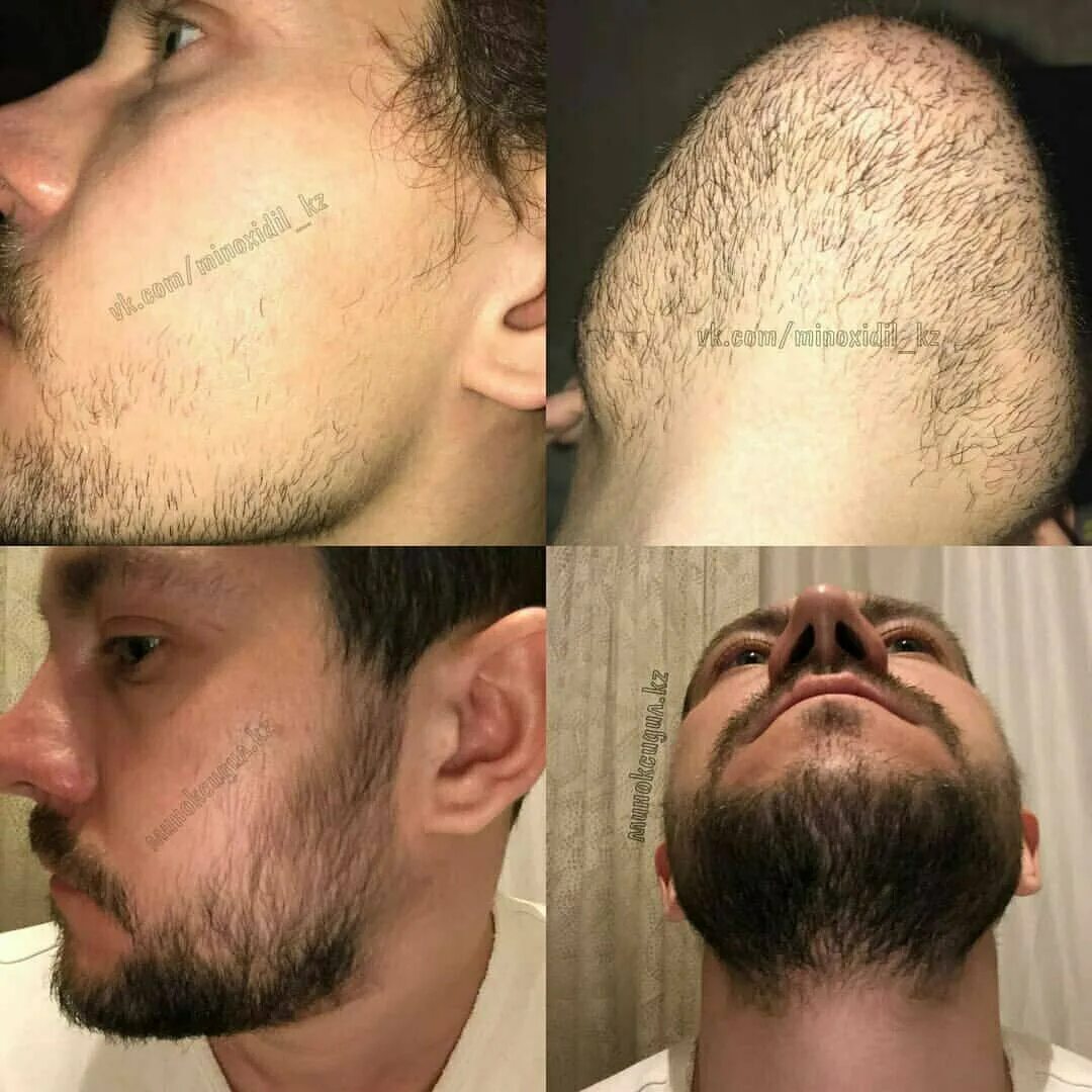 Рост волос на лице у мужчин. Миноксидил для бороды. Миноксидил щетина. Средство для отращивания бороды миноксидил. Мазь для бороды миноксидил.