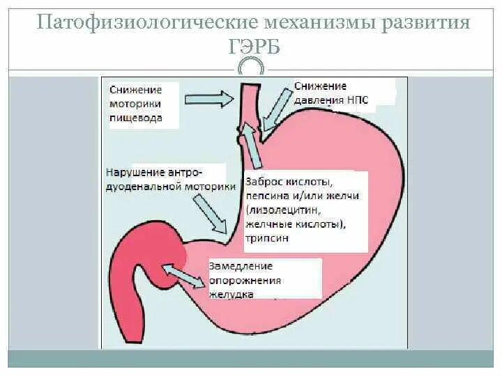 Расширен пищевод желудка. Гастроэзофагеальный рефлюкс этиопатогенез. ГЭРБ И хронический гастрит. Гастроэзофагально-рефлюксная болезнь диагностика.