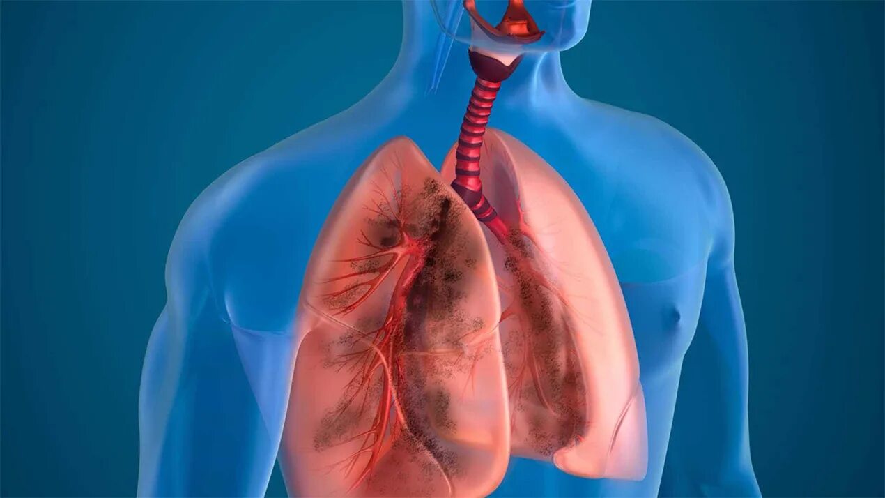 Бронхиальная болезнь легких. Патология органов дыхания. Поражение органов дыхания.