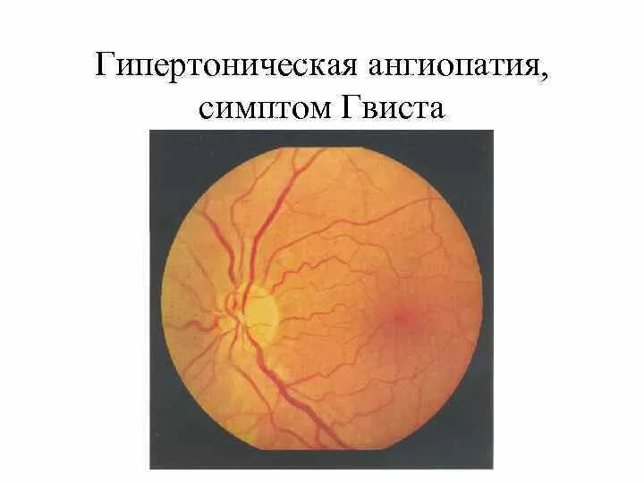 Гипертоническая ангиопатия глаза. Ангиопатия сетчатки глаза. Ангиопатия сетчатки глазное дно. Гипертоническая ангиопатия сосудов.