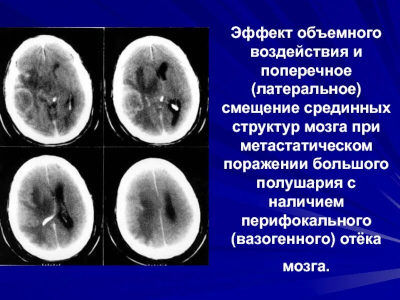 Без перифокальной реакции. Смещение срединных структур. Перифокальный вазогенный отек. Смещение срединных структур мозга.